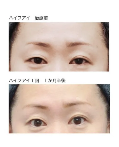 ハイファイ 治療前と1回1か月半後