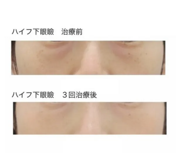 ハイフ下眼瞼 治療前と3回治療後
