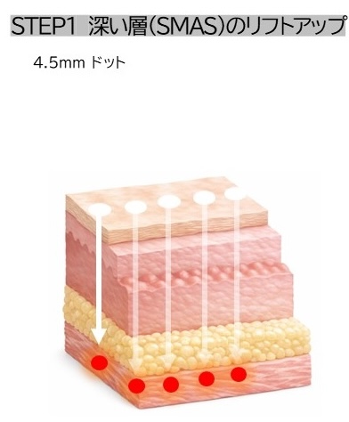 STEP1 深い層(SMAS)のリフトアップ 4.5mmドット