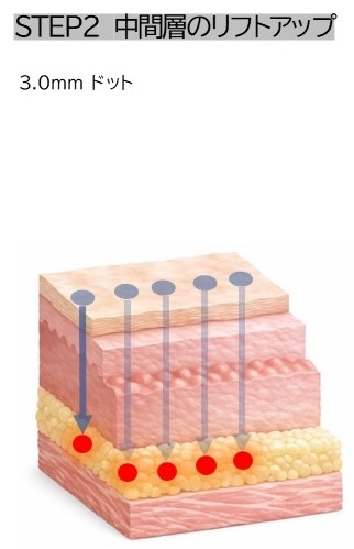 STEP2 中間層のリフトアップ 3.0mmドット