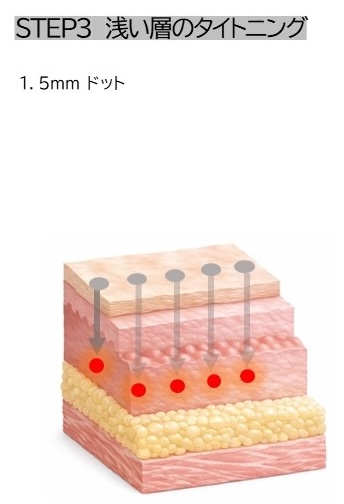 STEP3 浅い層のタイトニング 1.5mmドット