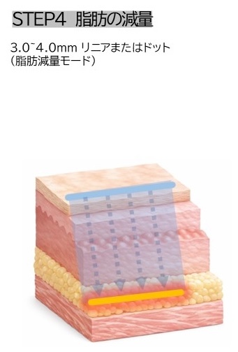 STEP4 脂肪の減量 3.0/4.0mm リニアまたはドット（脂肪減量モード）