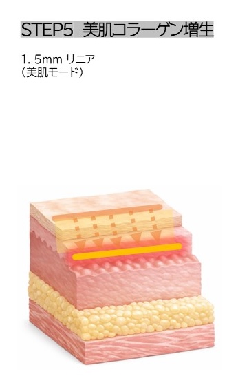 STEP5 美肌コラーゲン増生 1.5mmリニア（美肌モード）
